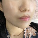 메디포올 | 강남리프팅관리 메디포올에서 원쎄라 맞춤 관리 후기