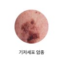 기저세포 암종 이미지