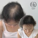 에테르노 뷰티 | 양산두피문신 에테르노에서 자연스런 변화