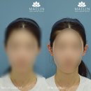 귀일지 | 대구귀필러후기 얼굴이 작아보일까?
