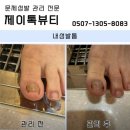 안양내성발톱 병원없이 관리 케어 이미지