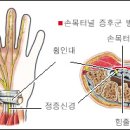 팔 다리 시리고 저린증상... 이미지