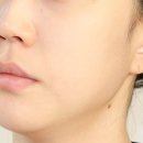 송파피부과 인에이블 스킨부스터 엑소좀 후기