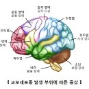 교모세포종[glioblastoma] 이미지