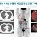 폐암의 경고 신호? 폐결절 증상 및 원인과 치료 방법 고립성 폐결절 이미지