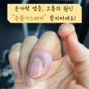 사천프라자 약국 | : 손톱가시, 손톱거스러미 뜯지마세요!! 손가락 염증, 고름 병원 추천( •́ ̯•｡̀ ) [조갑주위염]
