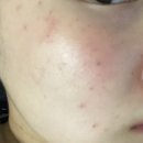 [신림피부과]신림역 피부과 닥터제이미의원 잡티, 점 제거 내돈내산 후기 (사진 후기有) 너무 만족중