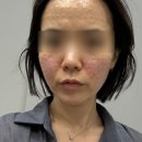 물광피부 - 성남시 중원구 둔촌대로 388 | 찐리쥬란 스킨부스터 엠보, 효과 등 속건조 개선과 물광피부 만든 후기