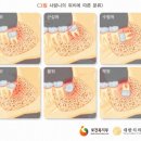 금곡의원 | 사랑니 무조건 뽑는 건 아닙니다. 금곡역치과