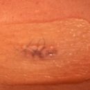 메디셀플러스의원 | [흑색종] 흑색종(피부암) 의심, 양재 피부과 조직검사 후기(D+4)