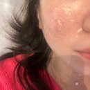 호산한의원 | 예한의원 여드름 흉터 치료 한방 SL재생술