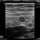 R/O infectious terminal ileitis. 이미지