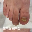 레푸스강남세곡점 | 세곡동 발관리샵, 발톱전문관리 이럴 때 받아보세요! [레푸스 강남세곡점]