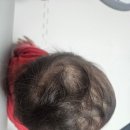 충남대학교 | 충남대학교병원 피부과 다녀온 후기｜소아 모발 진료 기록