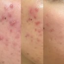 77 | 아누아 어성초 77 토너 후기 여드름 색소침착 진정 관리법