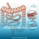 장협착[Bowel stricture] 이미지