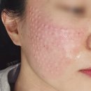 스노우의원전주점 | 리쥬란 스킨보톡스 가격 통증 엠보 내돈내산 후기 : 본식 한 달 전 강남 피부과 손주사 솔직리뷰