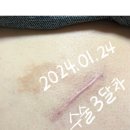 하원호성형외과의원 | 안동 하원호 성형외과 흉터제거 시술 후기💉