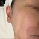 압구정로 | 청담피부과 혈관레이저 브이빔 레이저 후기