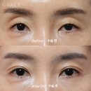 우일의원 | 눈꺼풀꺼짐교정 - 필러 아닌 아이홀 지방이식