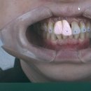 커스텀기공소 이미지