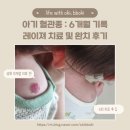레이져 | 아기 혈관종 : 레이져 6회, 바르는 안약 치료 완치 후기 (6개월 기록)