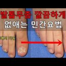 발톱무좀에 좋은 민간요법 이미지