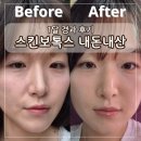 강남뷰티업성형외과의원 | 스킨보톡스 효과 가격 경과후기 강남 플레저성형외과