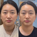 시크릿타임으로 달라진 윤곽! 향남 피부관리 <시크릿타임> 림프윤곽관리 리얼후기