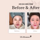 통영미래메디칼빌딩 | 부산 서면 피부과 이중턱 고민 해결, 서면 인모드 잘하는 곳 솔직 후기 (전후 사진 비교)