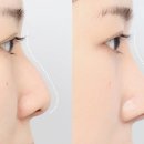 에이비성형외과의원 | 에이비성형외과 코성형 잘되는 코, 따로 있을까?