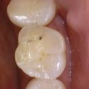 링구얼라인 이미지