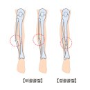 근골격질환인 경골과 비골 골절(Fracture of tibia &amp; fibula)이란? 이미지