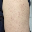 팔이합성 | 모공각화증 피부연화제 닭살피부 벗어난 후기 + 사진