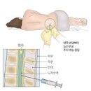 세균성 성인 뇌수막염 증상 원인 검사 방법 이미지