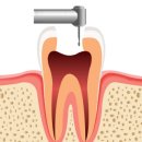 신경 치료[endodontic treatment] 이미지