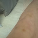 바디닥터짐 | [바디착색크림 추천] 닥터샤이 다크스팟 크림 3세대 사용후기｜겨드랑이·팔꿈치·무릎 착색관리 톤업...