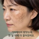21세기미 | 수원기미레이저 후 더 짙어진 이유? 핵심은 '이것'