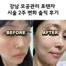 옐로우의원 | 강남 모공관리 포텐자 모공팁 풀페이스 가격 및 시술 2주 변화 솔직 후기