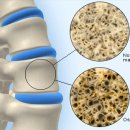 뼈의 역할과 골다공증, 종류 이미지