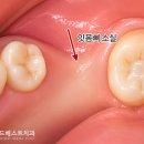 장전치과의원 | 장전역치과 어금니 상실, 방치하시면 안 됩니다