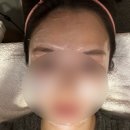 루나의원 | (내돈내산) 압구정 루나의원 루비레이저 후기