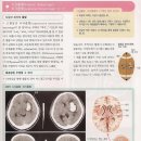 방사선- CT : 시상출혈, 피각출혈 . 소뇌출혈, 교뇌출혈 영상. 이미지