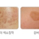 아문성형외과의원 | PDL 레이저 최저가 병원/ 서울 강동구 성형외과