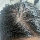 스칼프K | 정수리 탈모 앰플 여성탈모 | 퓨어그로우 루트 어웨이크닝 샷 스칼프 앰플 사용 후기