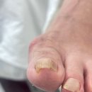 문제성 손,발 오감네일