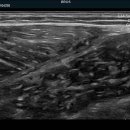 calf muscle tear 이미지