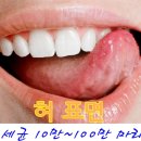 (건강 상식) 혀의 건강과 세균 이미지