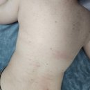 약수정한의원 | 오마주21스킨케어 등드름 관리(혐짤 주의)