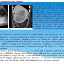 Pyogenic liver abscess 이미지